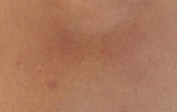 Trądzik różowaty — przyczyny, objawy i leczenie choroby skóry