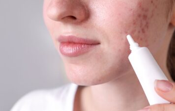 Leki na trądzik na receptę