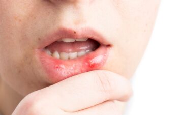 Recepta na lek na afty